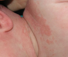 La psoriasis de que no basta
