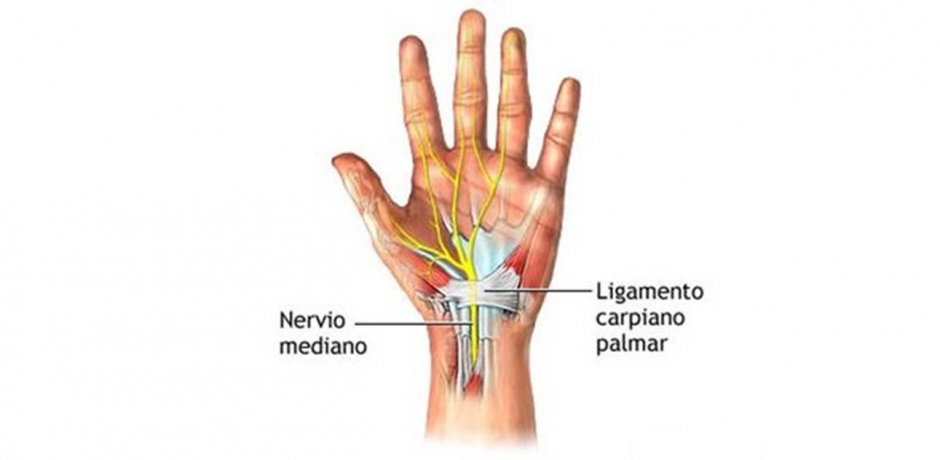 Qué es el síndrome del túnerl carpiano? - RP Clinic Fisioterapia Móstoles